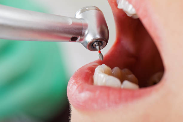 Emergency Dental Filling Replacement in VA